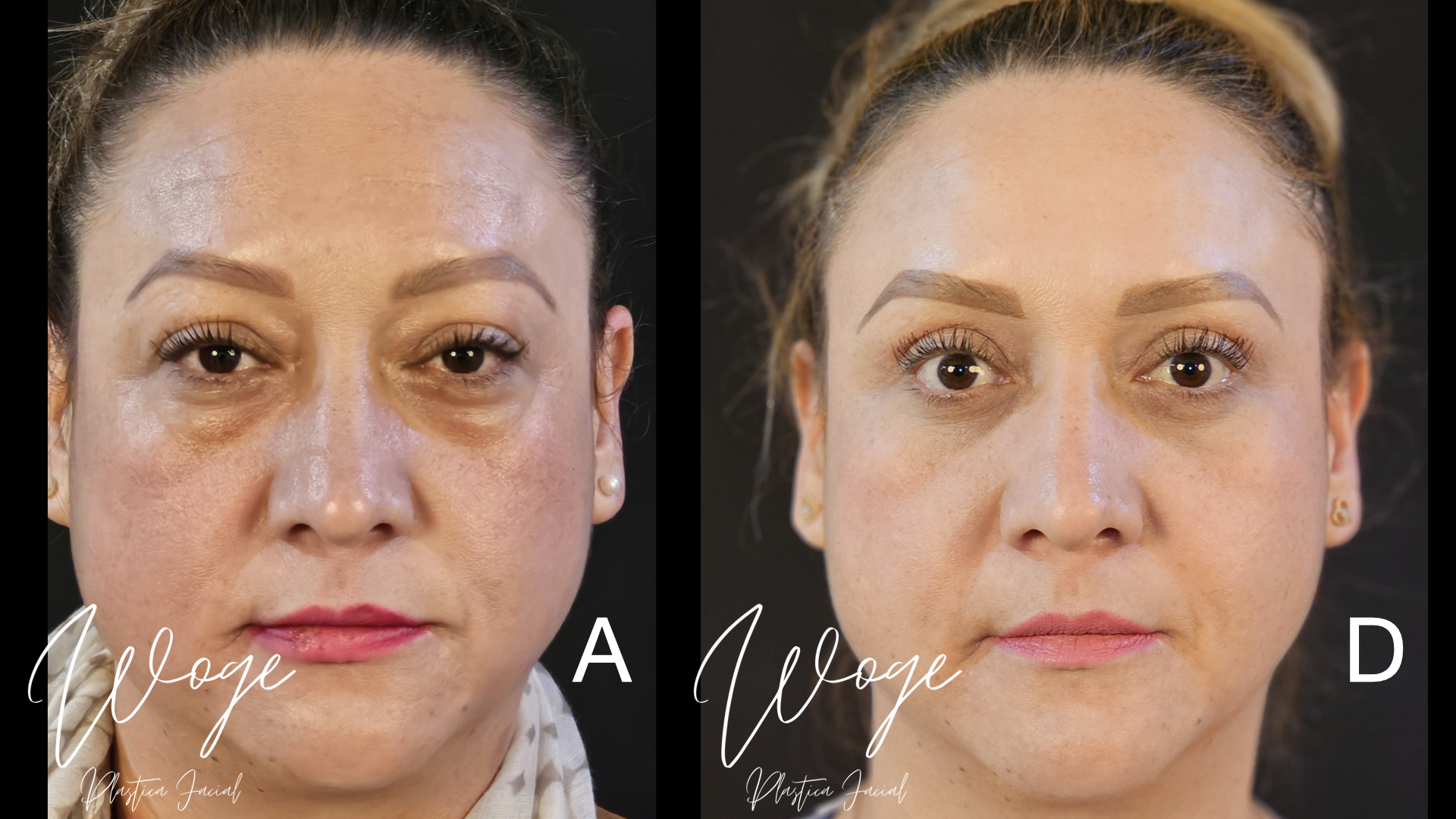 Blefaroplastia Antes y Después - Dr. Carlos Woge