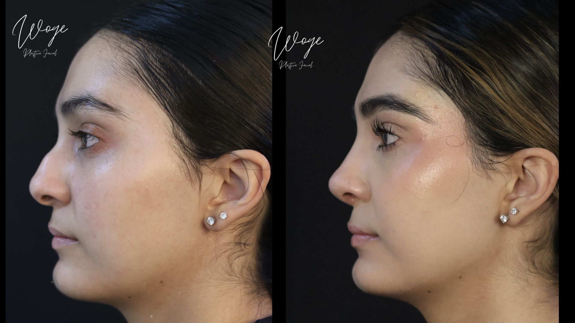 Rinoplastia Antes y Después - Dr. Carlos Woge