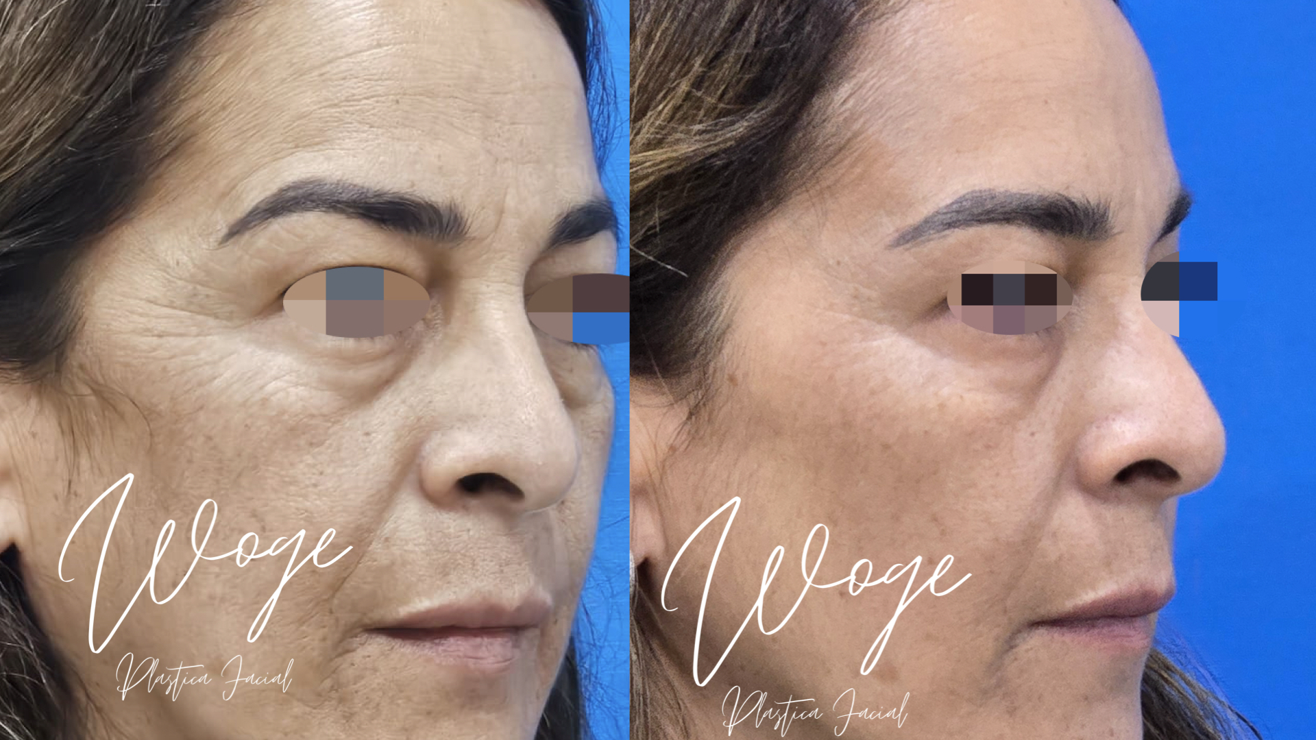 Toxina Botulínica Antes y Después - Dr. Carlos Woge