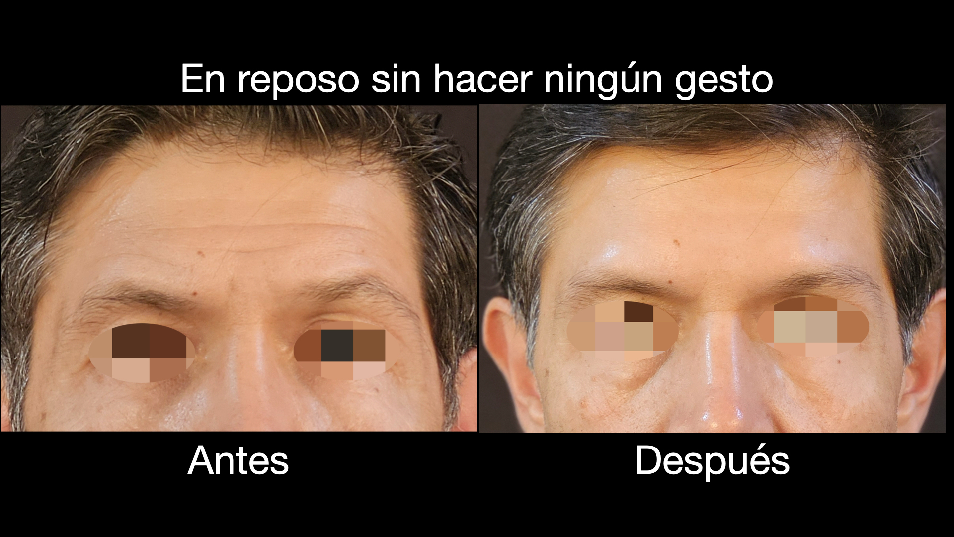 Toxina botulínica en reposo antes y después