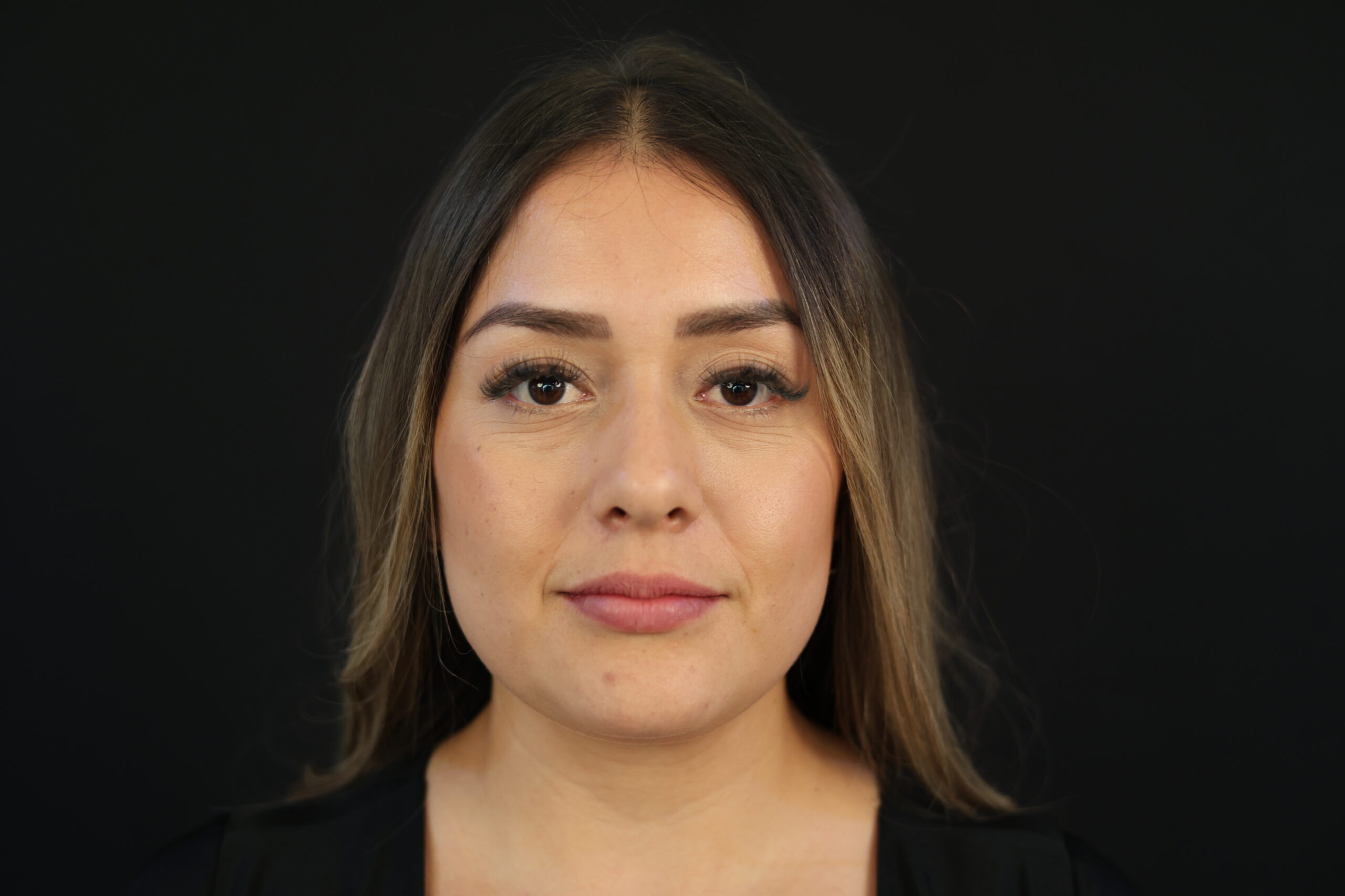 Lipoinyección Facial Antes - Dr. Carlos Woge