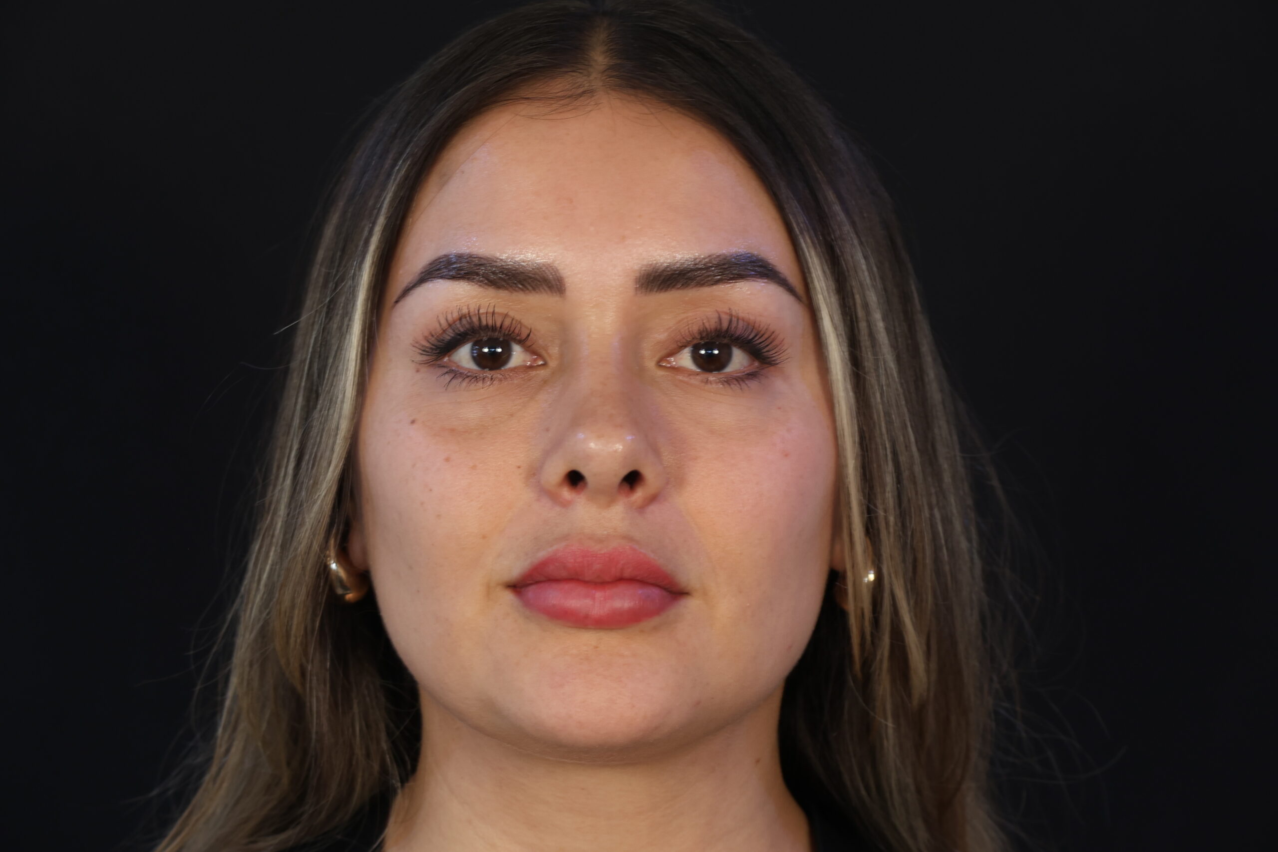 Lipoinyección Facial Después - Dr. Carlos Woge