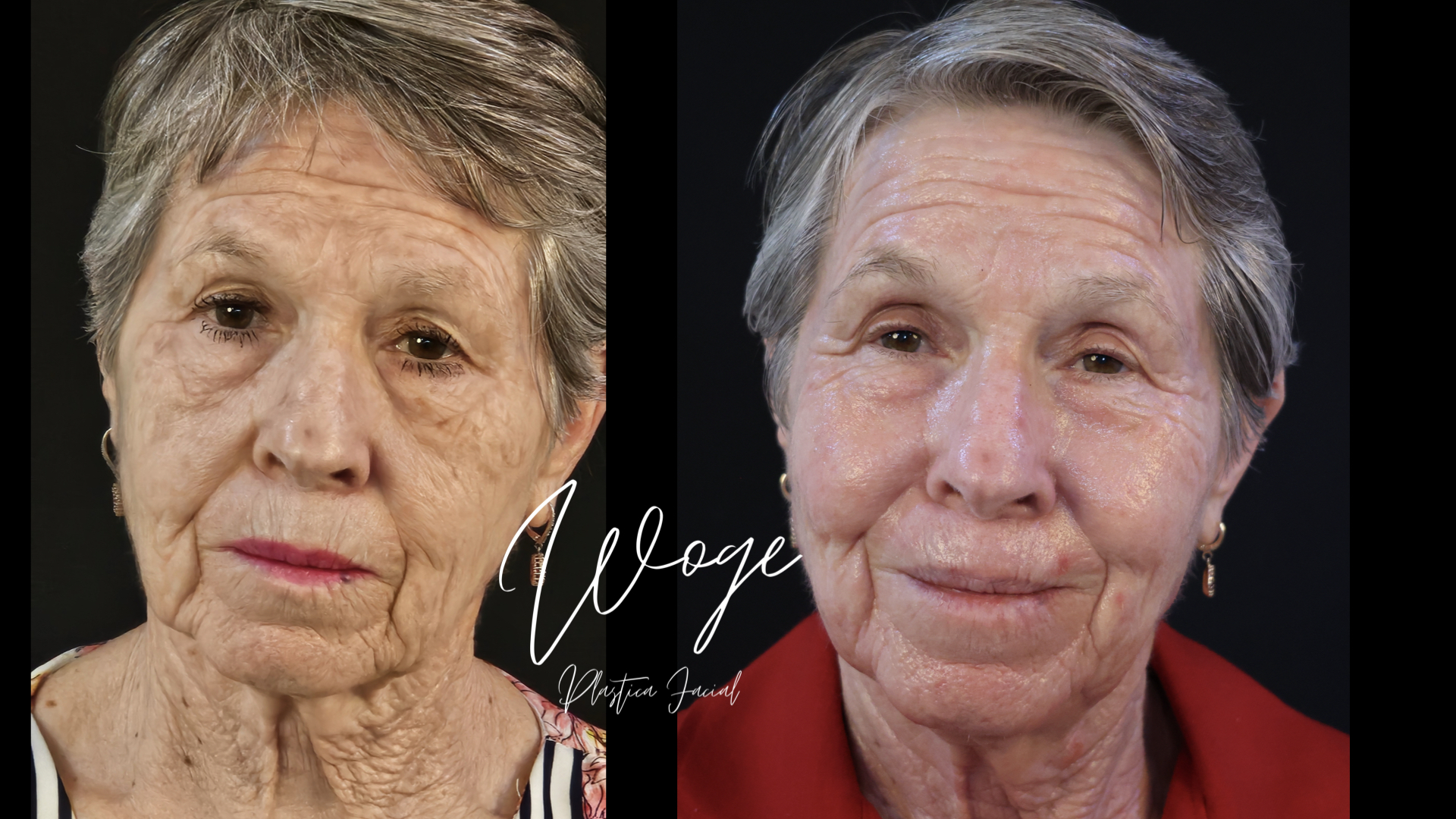 Rejuvenecimiento facial con láser antes y después - vista frontal - Dr. Carlos Woge