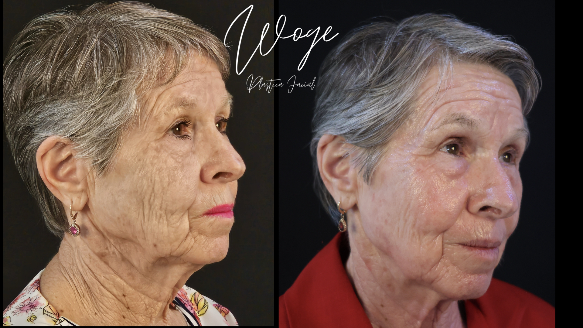 Rejuvenecimiento facial con láser antes y después - vista tres cuartos - Dr. Carlos Woge