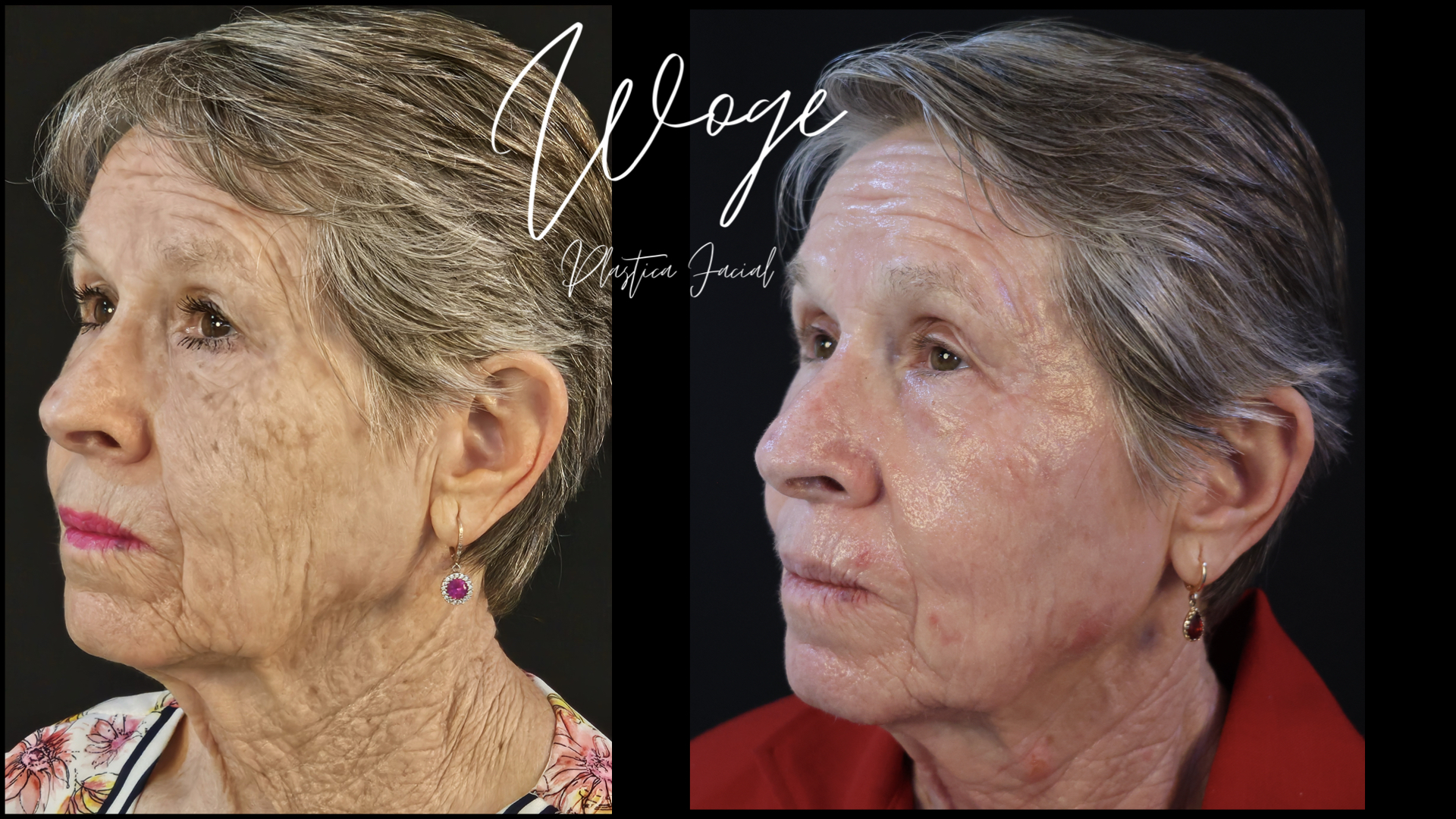 Rejuvenecimiento facial con láser antes y después - perfil - Dr. Carlos Woge