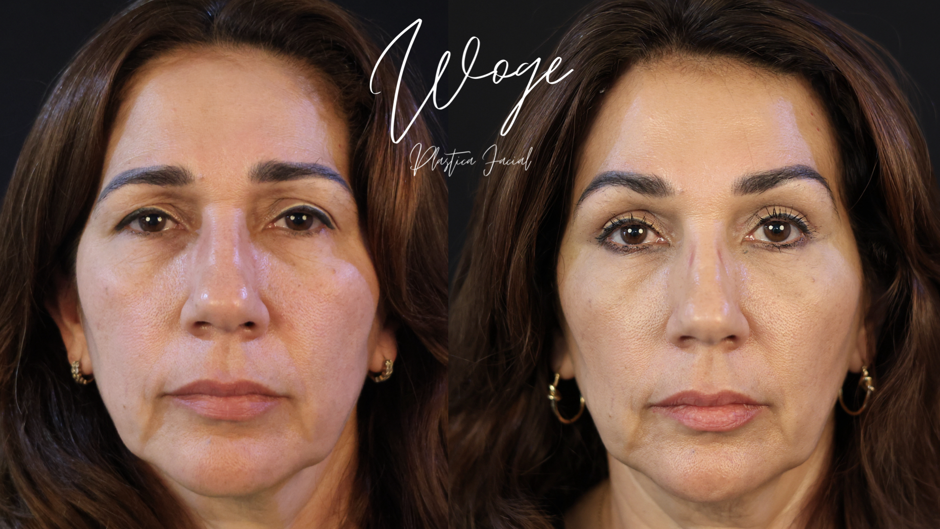 Lifting de Cejas Antes y Después - Dr. Carlos Woge