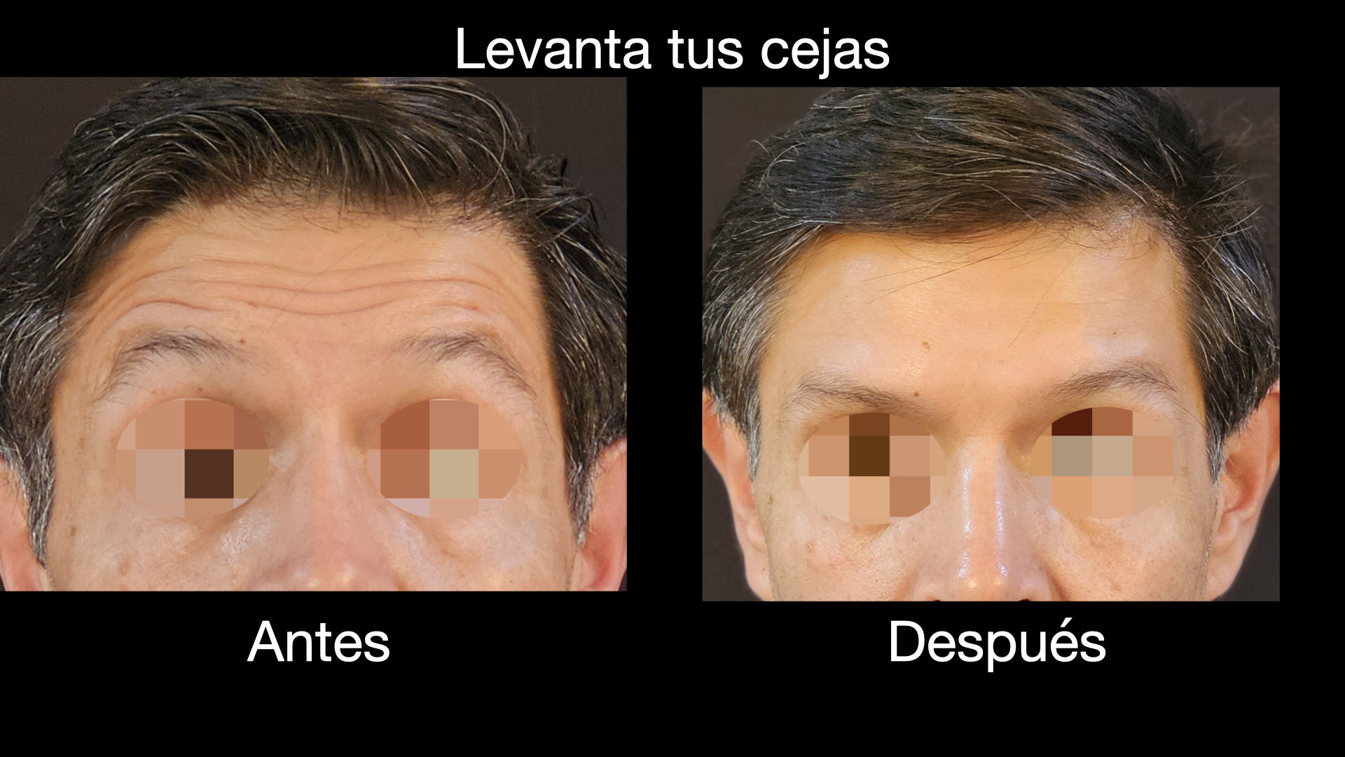Toxina botulínica antes y después