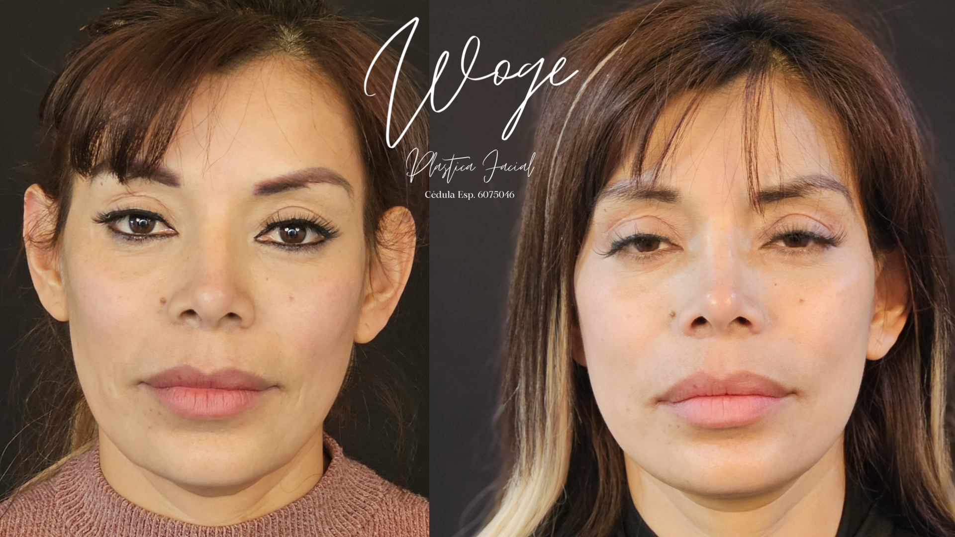 Facelift tercio medio vista frontal antes y después