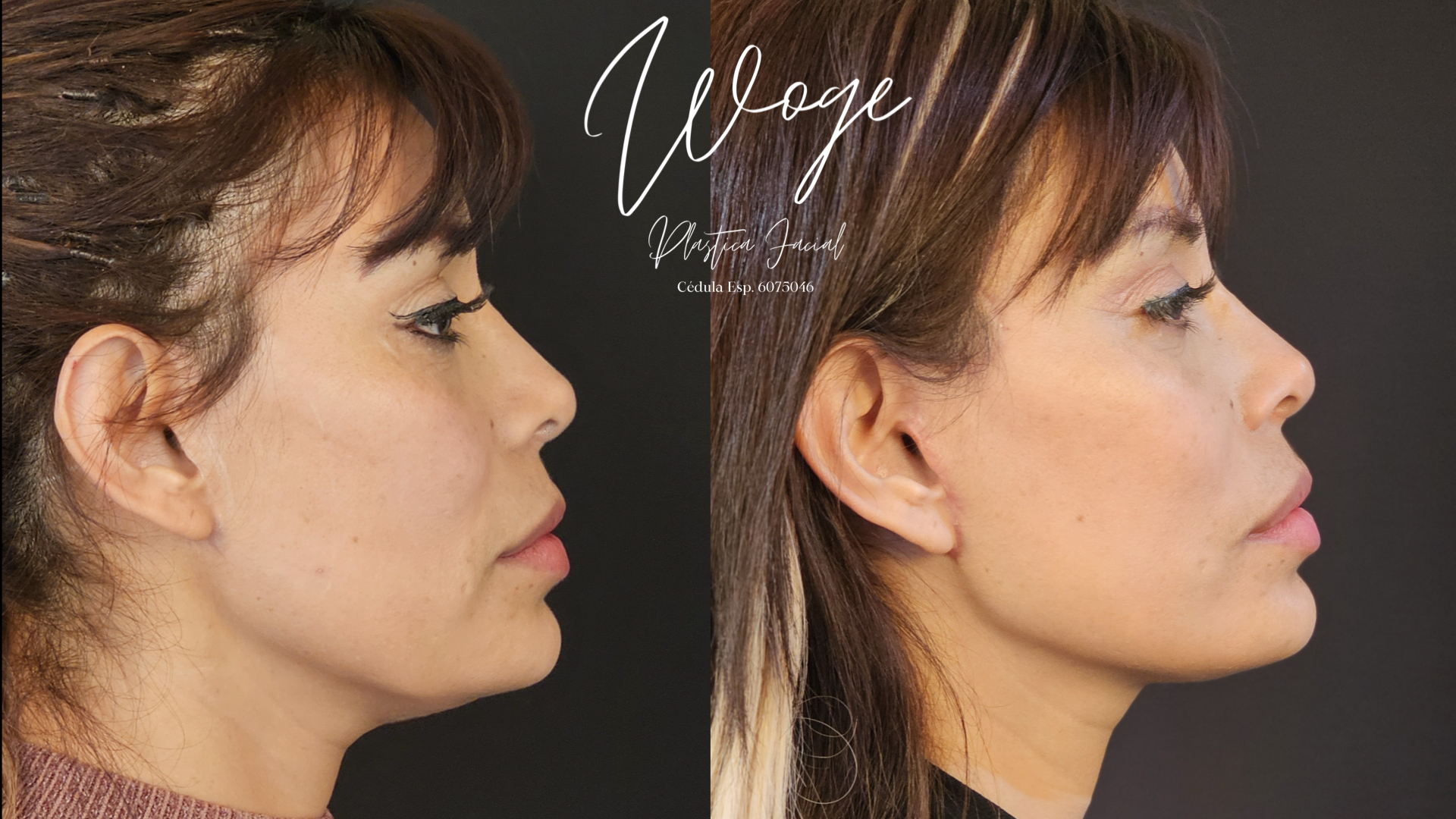 Facelift Estiramiento Facial Antes y Después - Dr. Carlos Woge