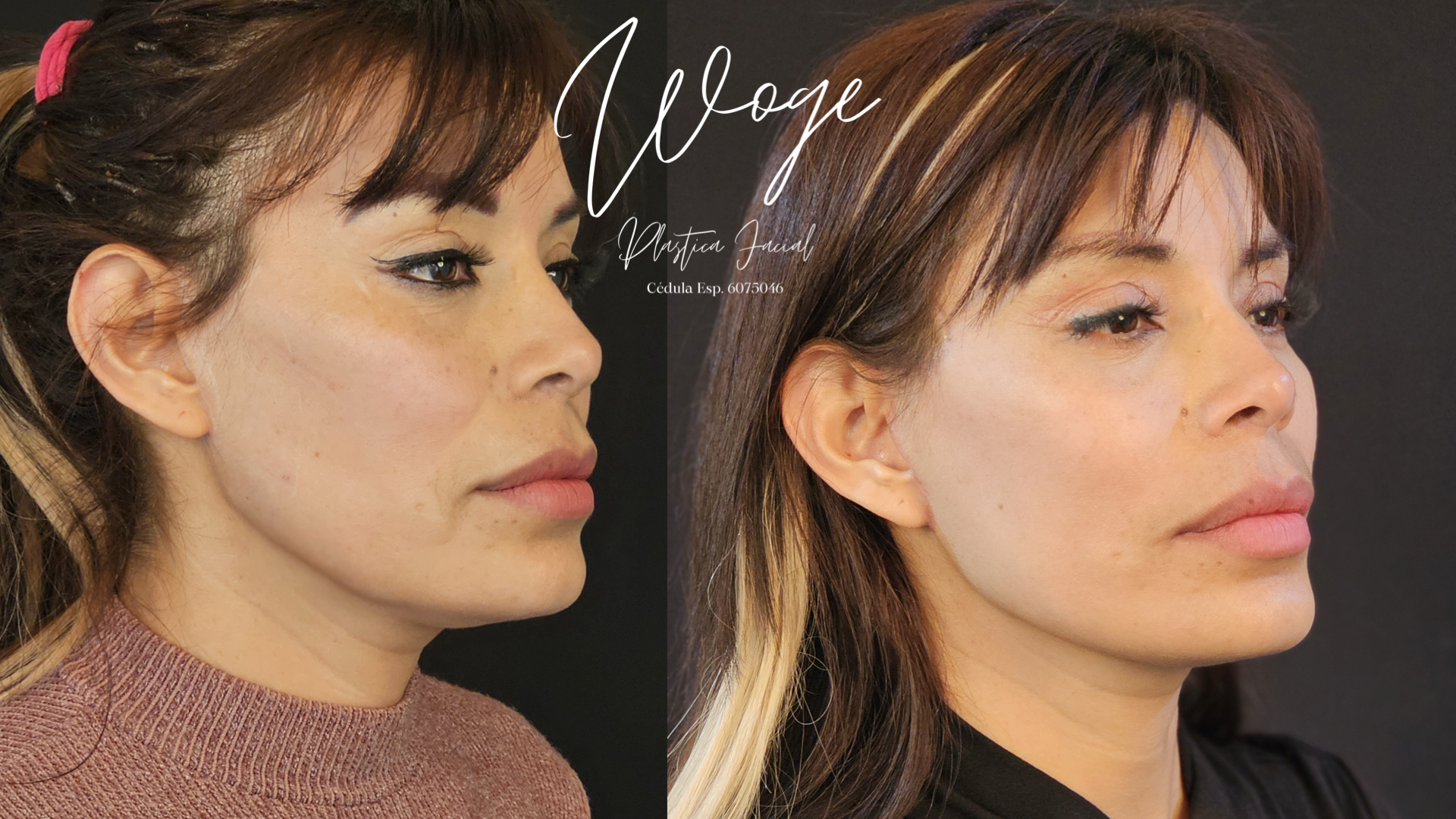 Facelift tercio medio antes y después