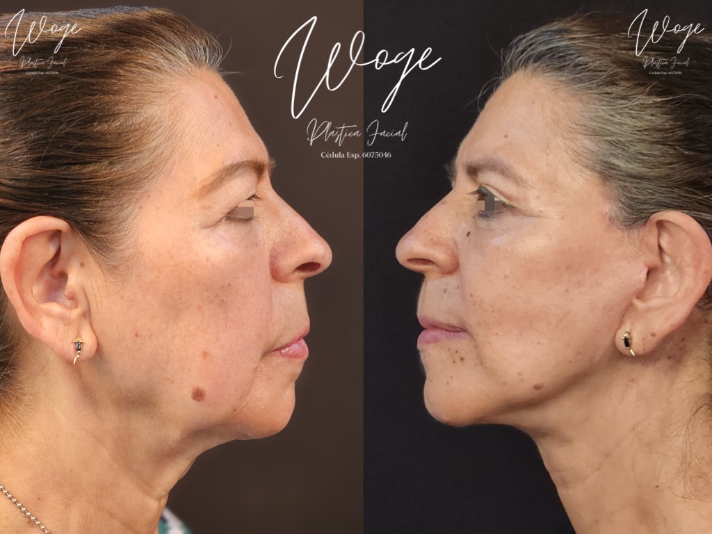 Lifting de Cuello Antes y Después - Dr. Carlos Woge