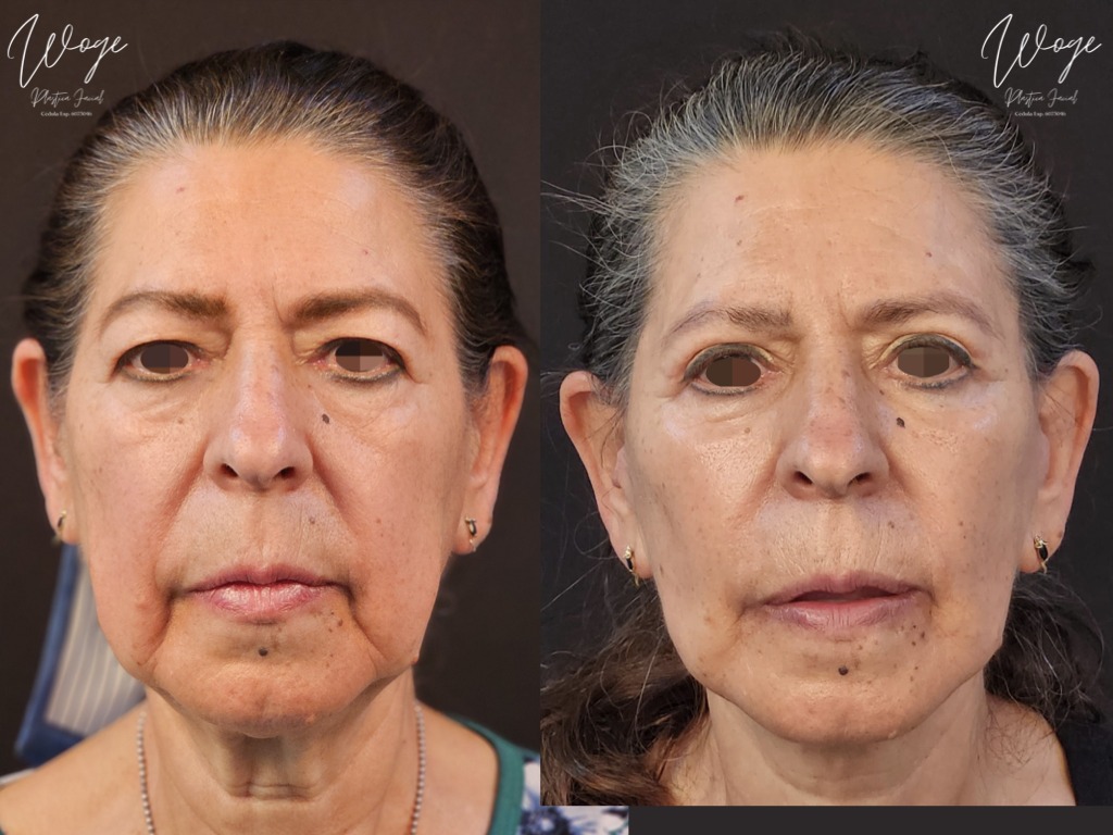 Neck lift antes y después