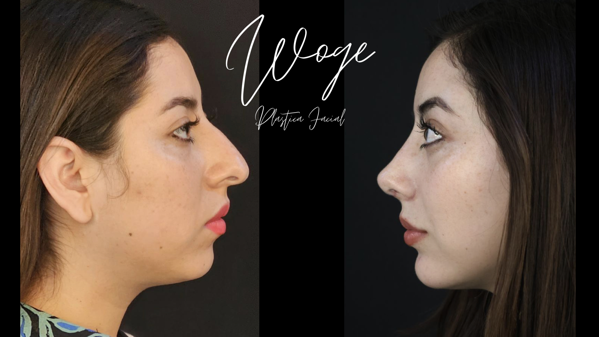 Rinoplastia Mentón y Bichectomía antes y después